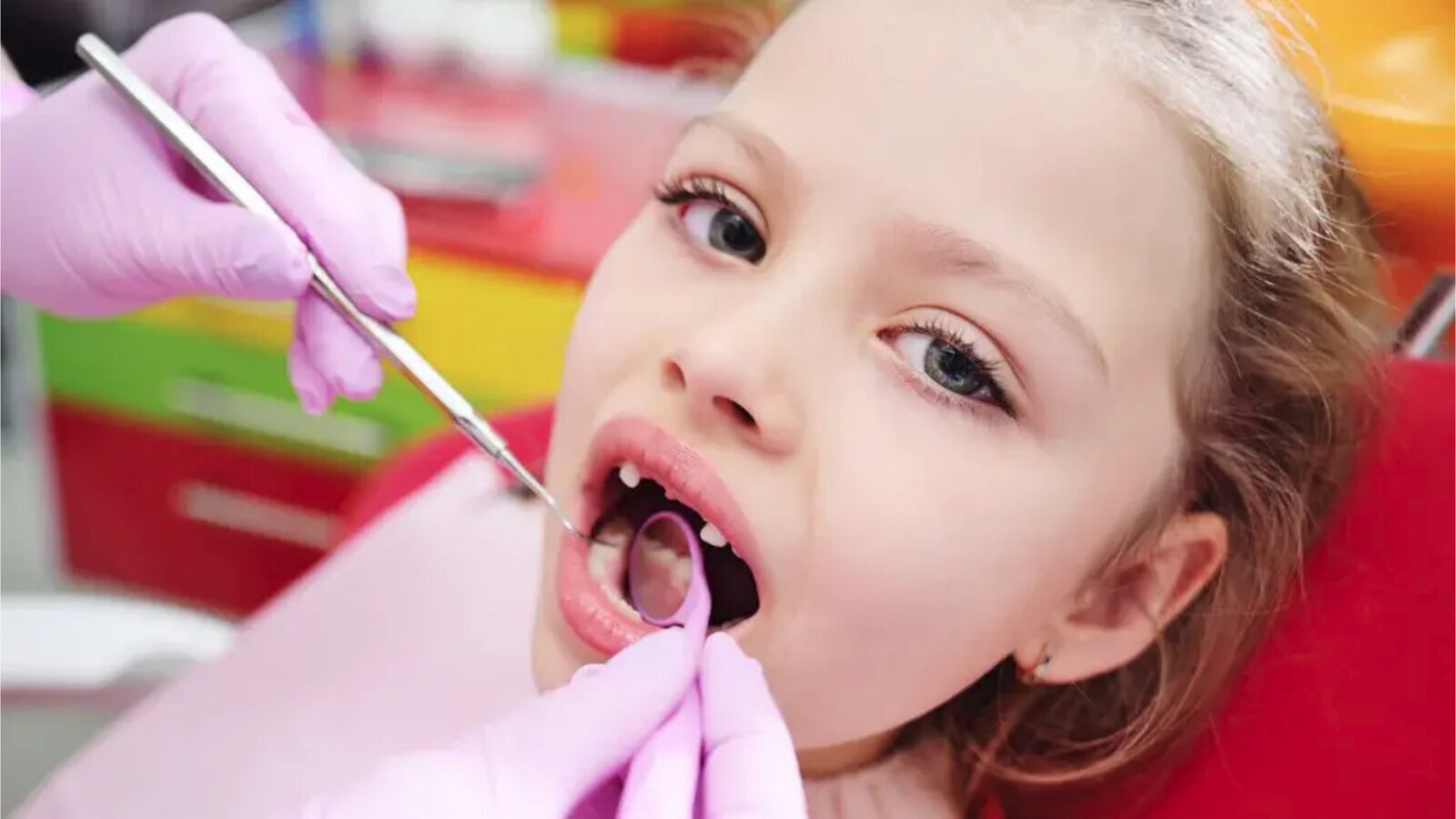 Istraživanje identifikovalo nove vrste bakterija koje su uključene u formiranje zubnog karijesa