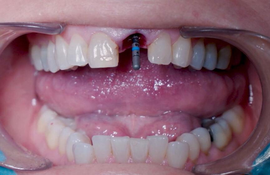 Fig. 7: 3D confirmation with Ø 2.2 mm alignment pin.