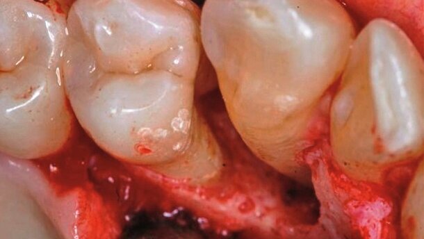 Zastosowanie laserów w ubytkach kostnych w obrębie przyzębia