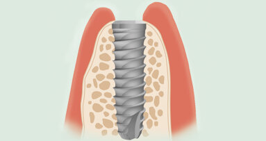 Respetando los principios fundamentales de la implantología