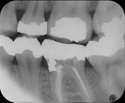 Afb. 4: Bitewing waarop lokalisatie en omvang van de perforatie zichtbaar zijn