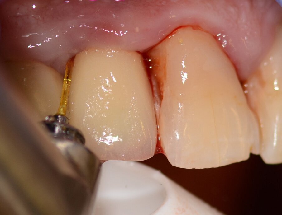 ...and surface ablation of infected bone.