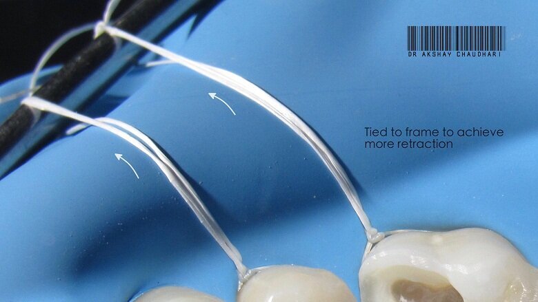 Floss Ligatures tied to Rubber dam frame