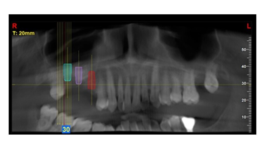 Fig. 4_CBCT a 5 mesi dal rialzo mascellare con approccio laterale.
