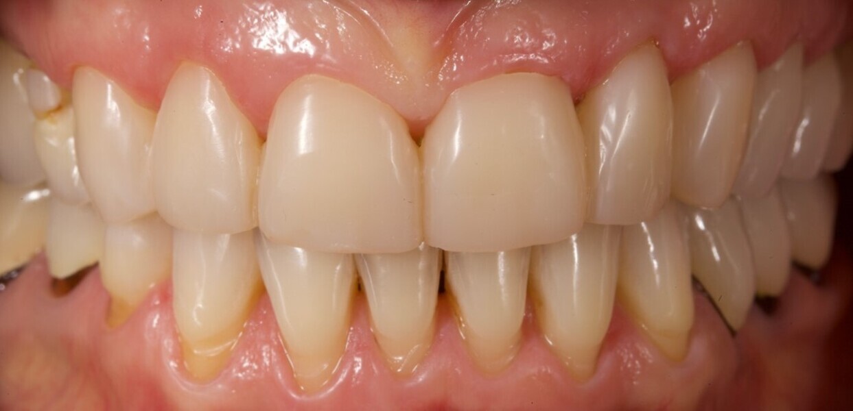 Fig. 14a: Immediate treatment outcome. Frontal view with the teeth in occlusion.