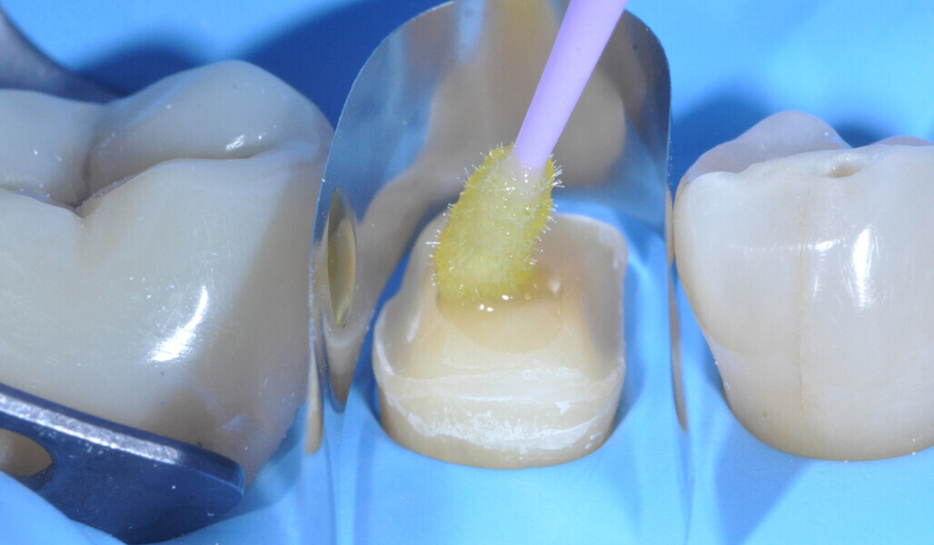 Fig. 20: Application of the universal adhesive to the tooth structure. 