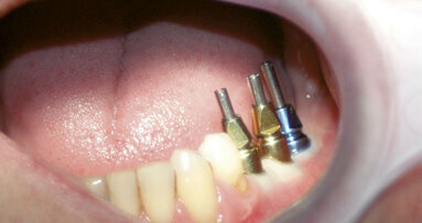 Impianti + Impronte ≠ Complicanze