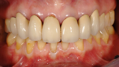 New paradigm in aesthetic restoration