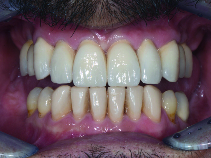 Fig. 21 : Vue postopératoire
: couronnes unitaires en zircone cubique stratifiée dans l’arcade maxillaire, et restaurations en composites injectés en technique directe dans l’arcade mandibulaire. 
