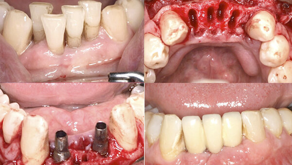 Factores clave en implantología