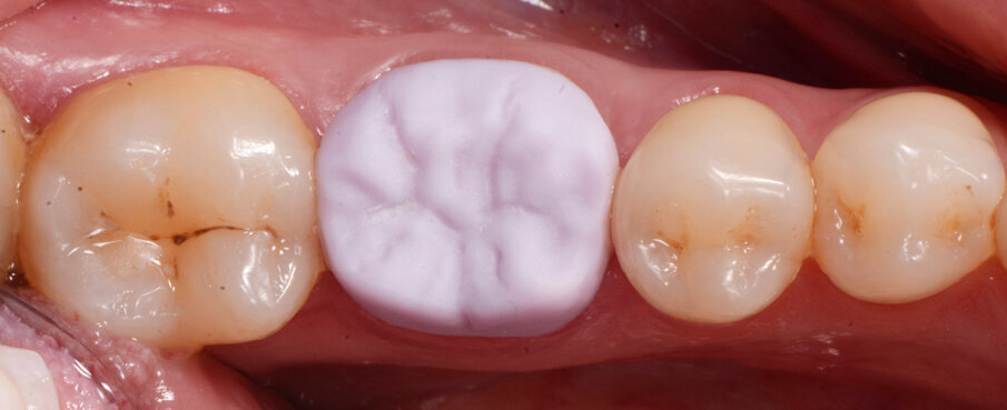 Fig. 3b: Crown design in the software suite (Cerec inLab) and try-in before crystallization firing (IPS e.max)