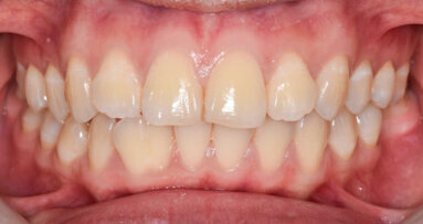 Pesquisadores descobrem como as bactérias orais podem afetar a agressividade dos cânceres de cólon