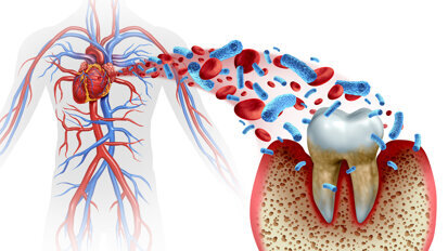 Alle vier großen Volkskrankheiten sind mit Parodontitis assoziiert