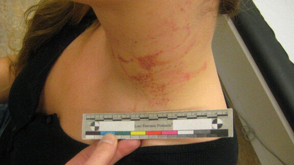 “Ook tandarts moet mishandeling durven en willen signaleren”