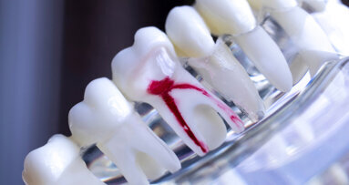 Wurzelbehandlung laut Studie besser als ihr Ruf