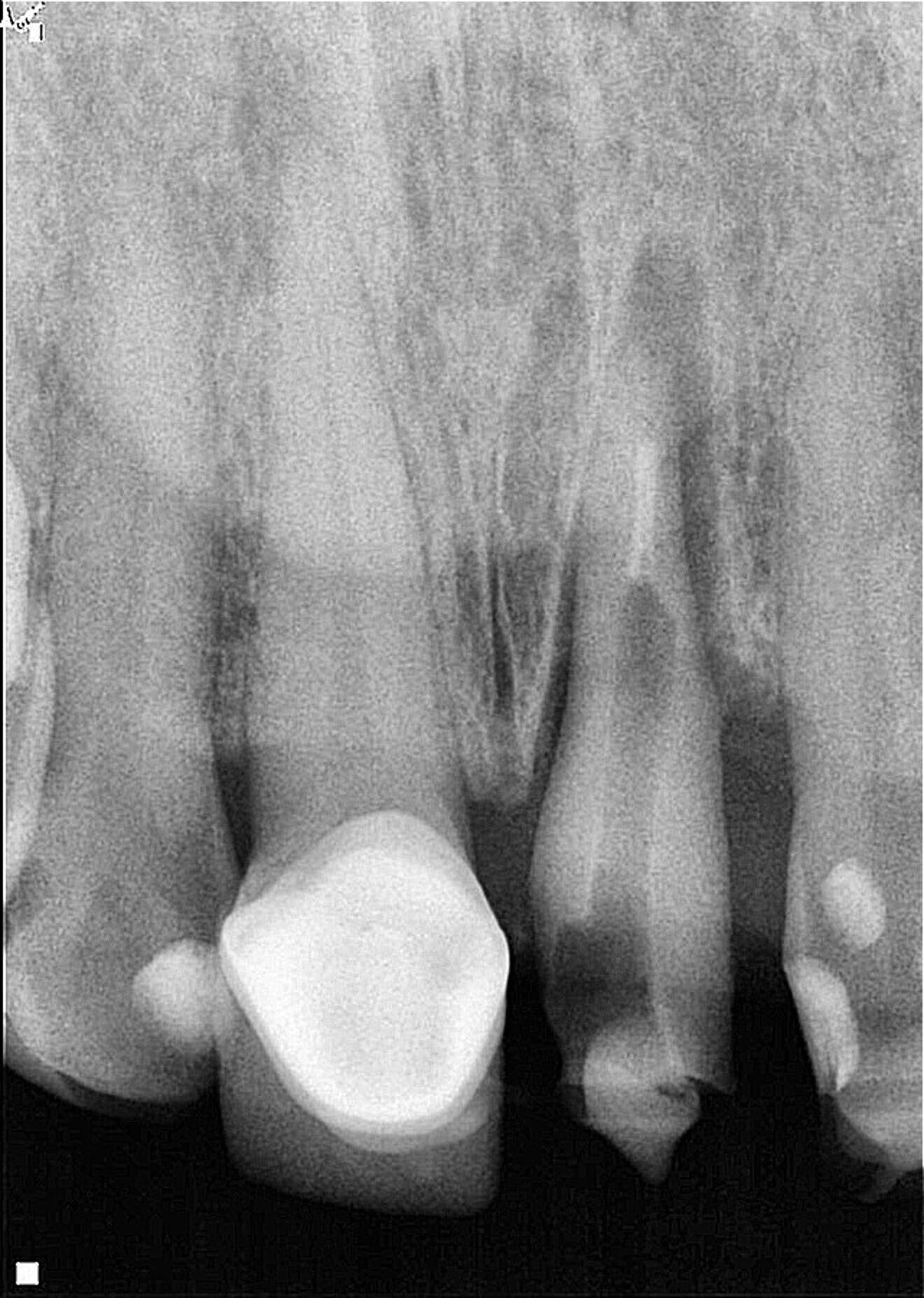 Fig. 2: Post-op radiograph of the tooth extruded by approximately 6 mm and rotated by 180°, locating the deeper zone of the fracture towards the mesial aspect. 