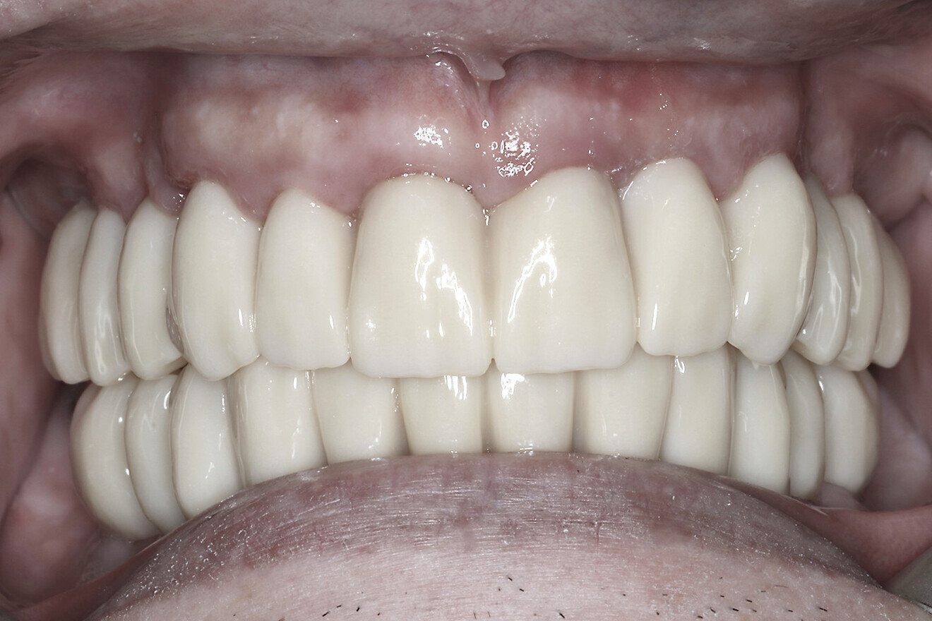 Fig. 17b: Retracted intra-oral view.