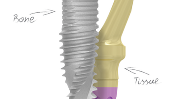 Revolucionaria innovación en implantes dentales