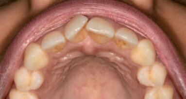 Inman Aligner - Efikasno sredstvo u minimalno invazivnoj „kozmetičkoj” stomatologiji (Prvi deo)