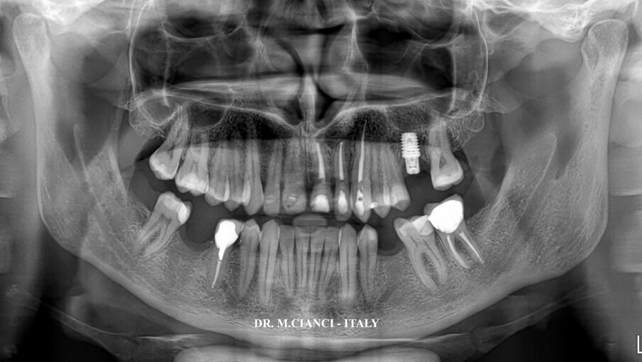 Fig. 12 - Opt post-chirurgica.