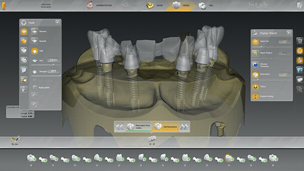 Nuovo Software: INLAB 15.0 “un software alla ricerca dell’arte odontotecnica”