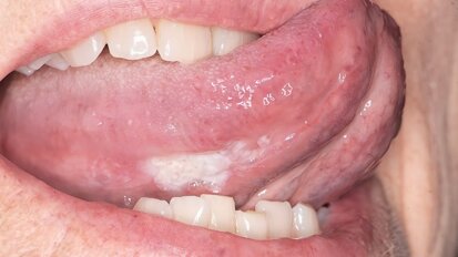 Un ensayo clínico frena lesiones orales precancerosas