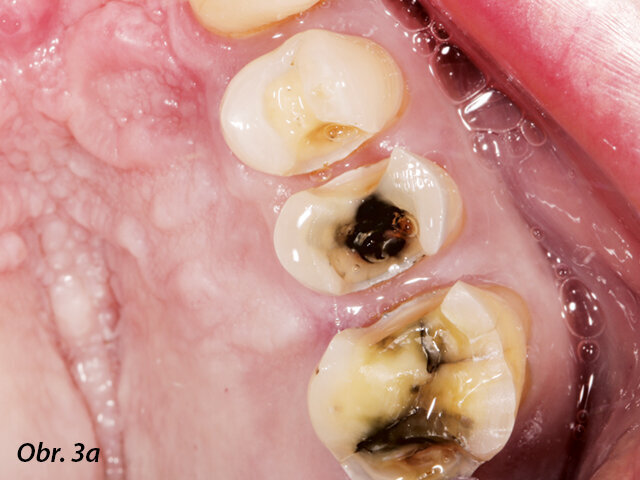 Preparované zuby jsou připraveny na intraorální digitalizaci (intraorální skenování).