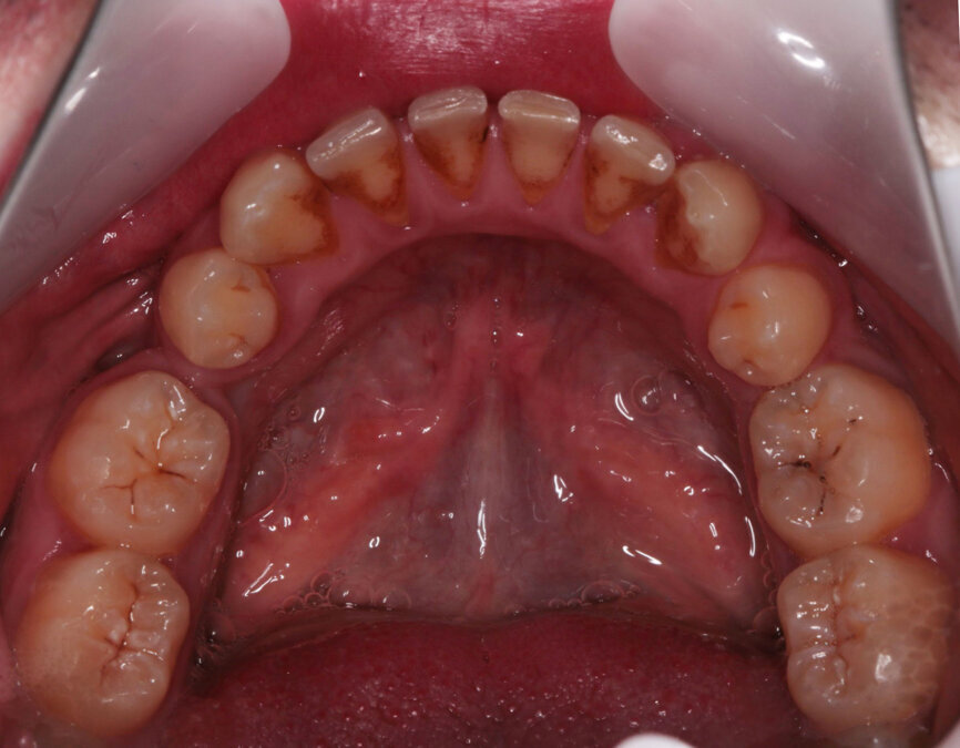 Fig. 6: Pre-treatment lower occlusal view