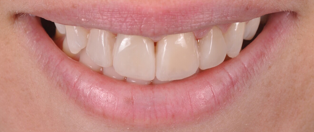 Fig. 20a: Treatment outcome. Smile view (a). 