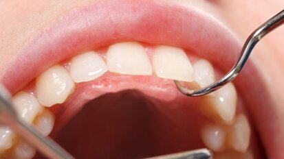 Onderzoek naar sterkere, duurzamere tandvullingen