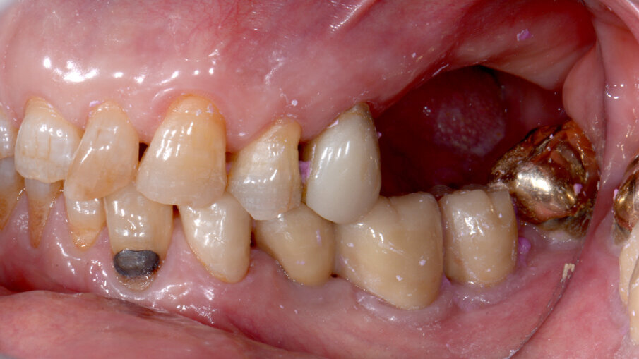 Obr. 13a–c: Intraorální snímky před ošetřením.