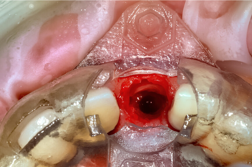 Fig. 22b: The final insert was designed to receive the guided sleeveless drills for accurate osteotomy preparation (a). The osteotomy was prepared to avoid
proximity to the remaining root fragment while leaving sufficient restorative space as previously planned (b).