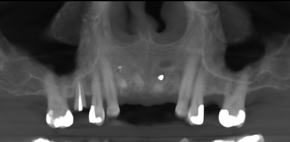 Fig. 7: CBCT scan of the maxillary anterior region after the extractions. 
