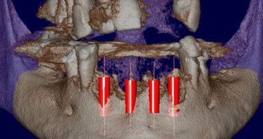 Diagnosi e pianificazione digitale pre-chirurgica in Rigenerazione Ossea Guidata