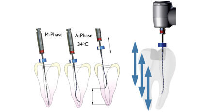 Endodontický restart: debridement s adaptivním jádrem a finální dezinfekce