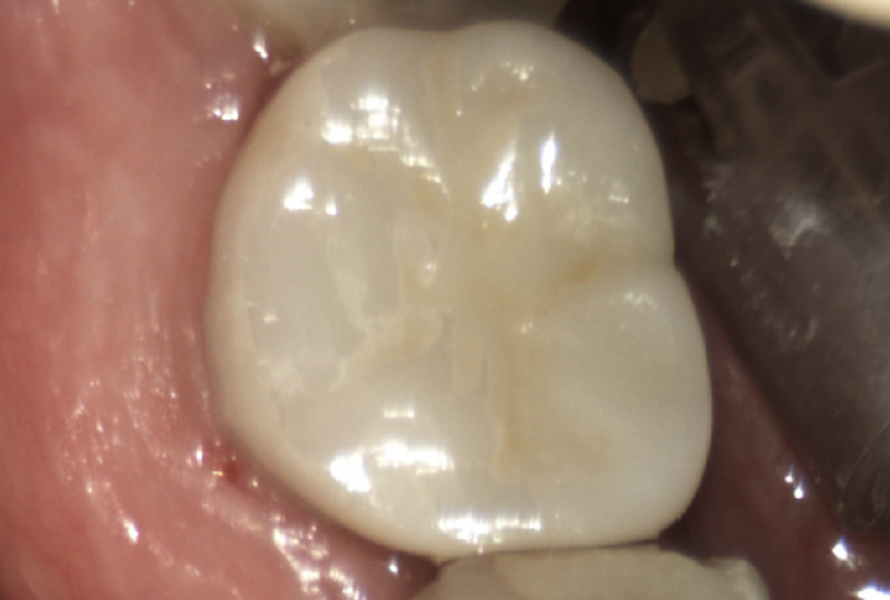 Fig. 6: Final restoration in situ.