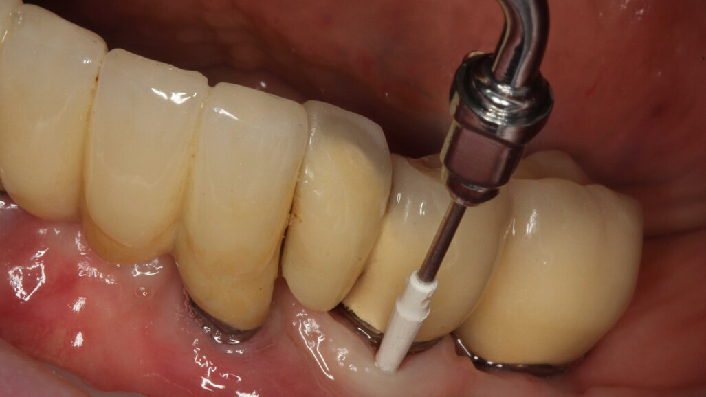 Guided Biofilm Therapy – Избягвайте рисковете при имплантите