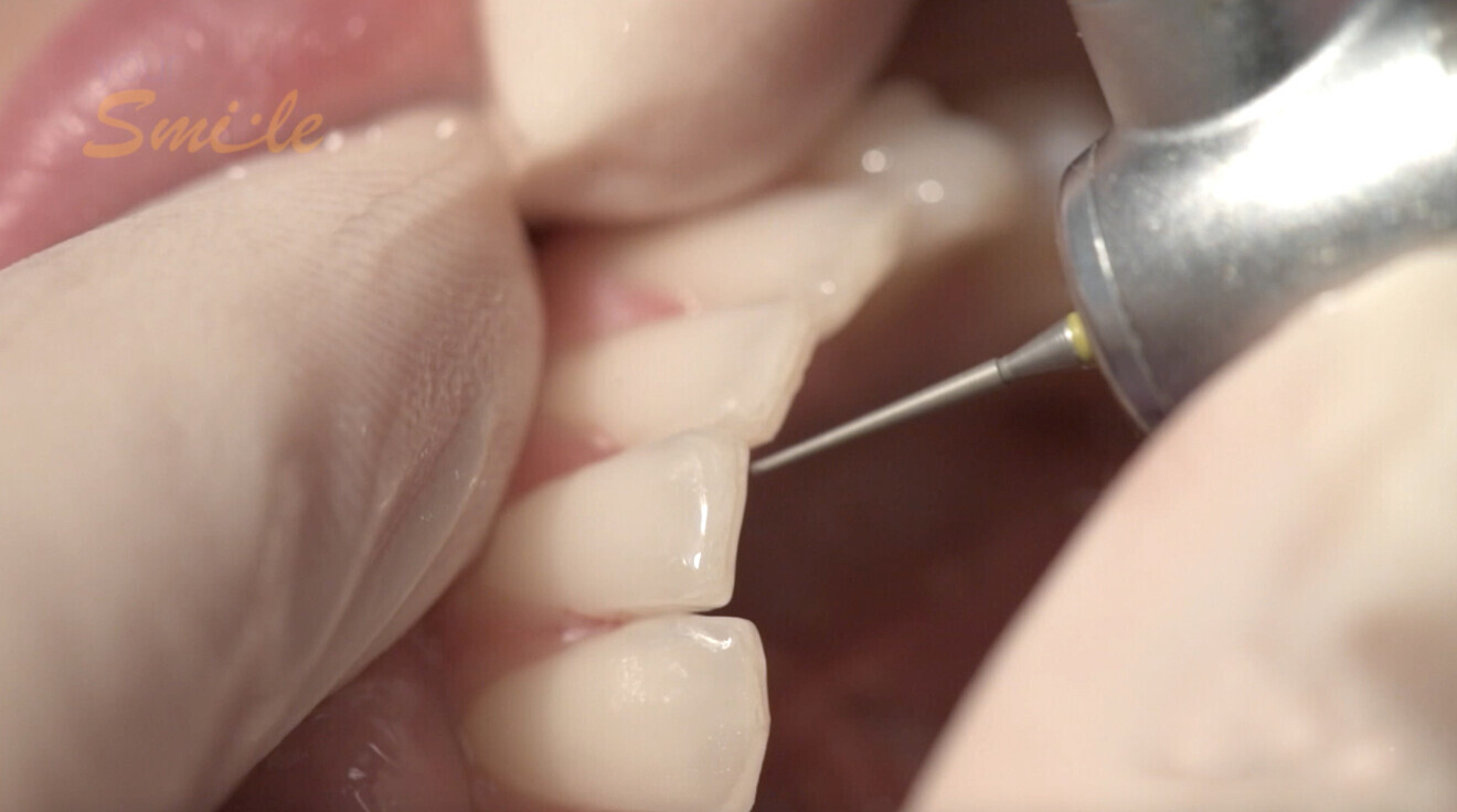 Fig. 13: Finishing the edge of the contact.