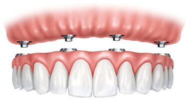 Le marché de la prothèse amovible supra-implantaire en France