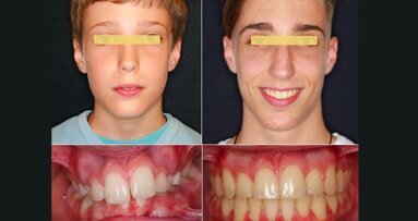 ¿Extracción o Expansión en Ortodoncia?