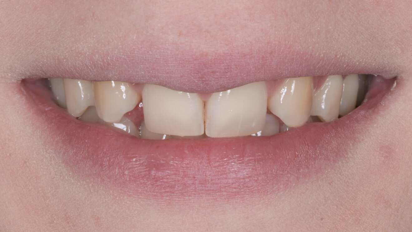 Fig. 2 : Situation initiale à l’échelle du sourire.