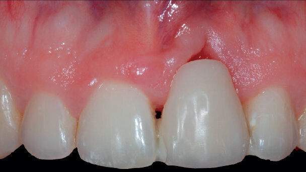 Potenzialità e limiti delle membrane riassorbibili cross linked a lento riassorbimento