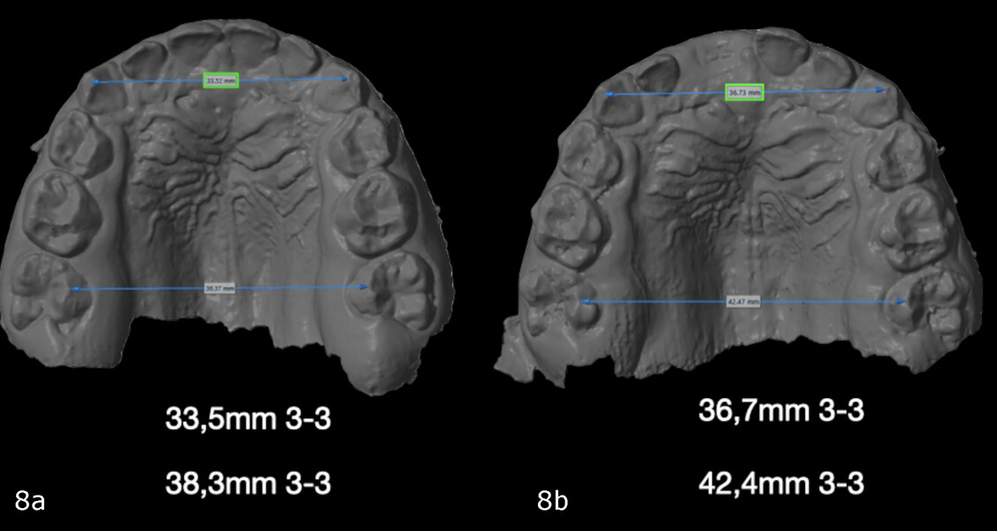 Figs. 8a & b: Palatal models before (a) and after the therapy (b) with width measurements: from 33.52 mm to 36.73 mm in inter-canine width and from 38.37 mm to 42.47 mm in inter-molar width.