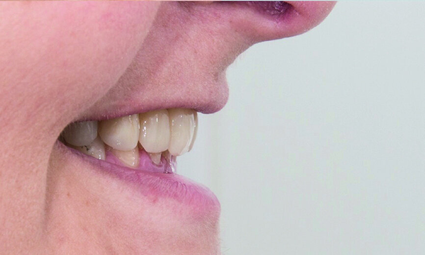 Fig. 12: Good support for the upper lip.