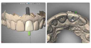 Digital dentistry: Three steps to enhance your dental implant laboratory