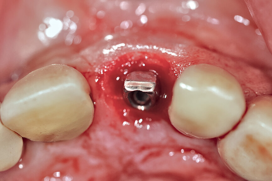 Fig. 26c: The abutment in place.