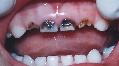 Coronas de resina vs. coronas de circonio en Odontopediatría