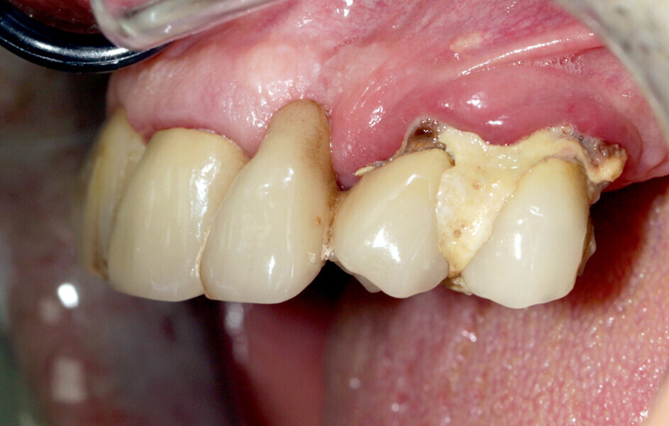 Fig. 10: Transverse bone insufficiency on the ridge of tooth #22.