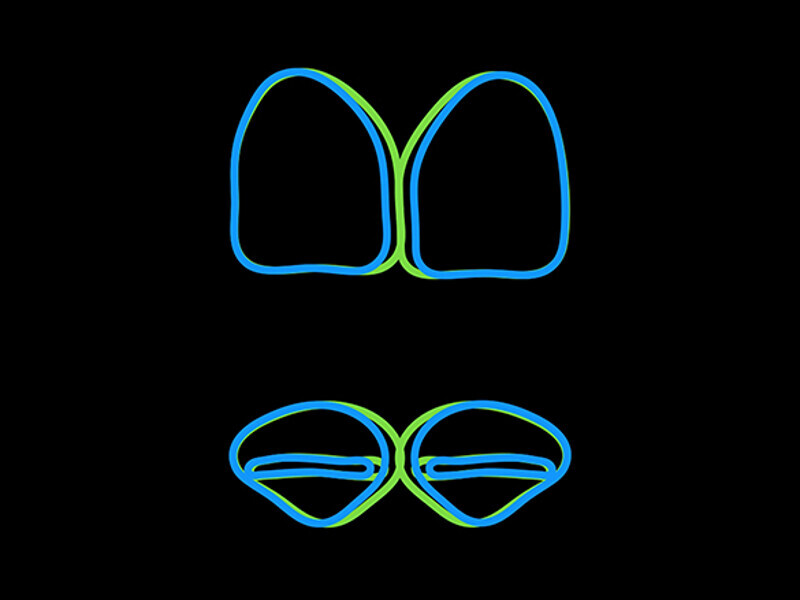 Figura 4. Formas de incisivos centrales reales e ideales.