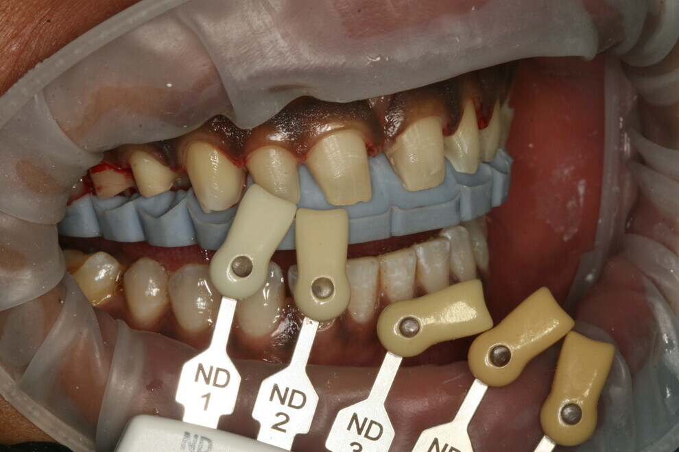 Fig. 3: Preparation shade. 